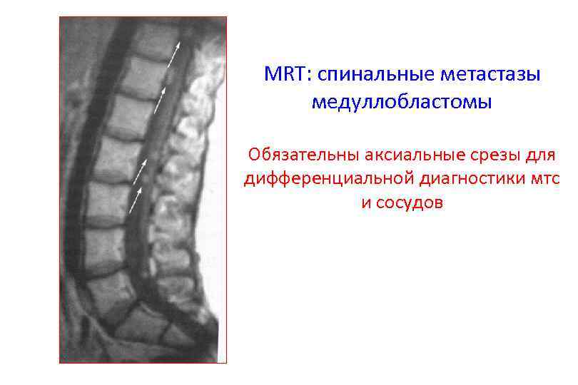 MRT: спинальные метастазы медуллобластомы Обязательны аксиальные срезы для дифференциальной диагностики мтс и сосудов 