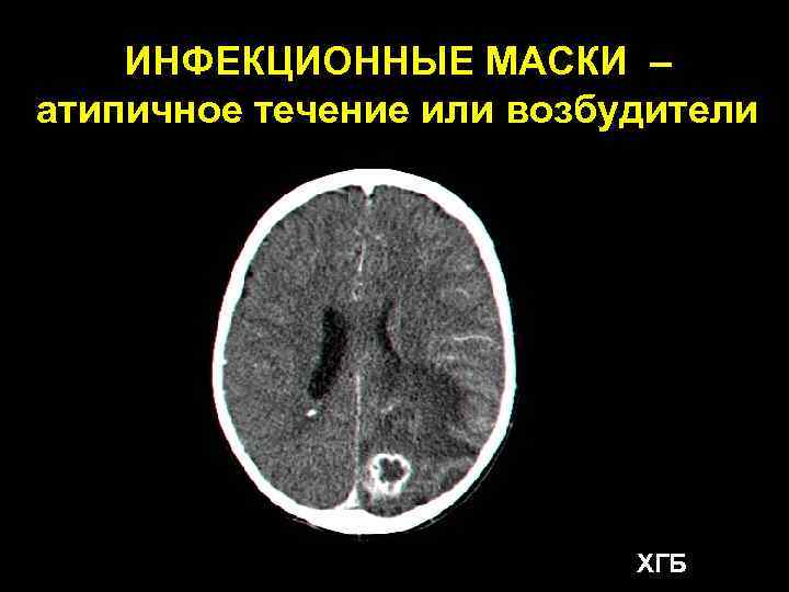 ИНФЕКЦИОННЫЕ МАСКИ – атипичное течение или возбудители ХГБ 