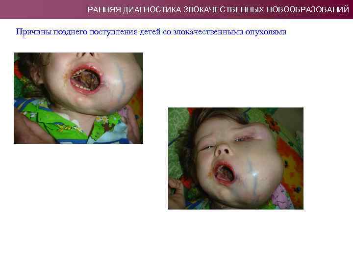 РАННЯЯ ДИАГНОСТИКА ЗЛОКАЧЕСТВЕННЫХ НОВООБРАЗОВАНИЙ Причины позднего поступления детей со злокачественными опухолями 