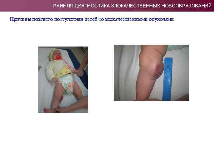 РАННЯЯ ДИАГНОСТИКА ЗЛОКАЧЕСТВЕННЫХ НОВООБРАЗОВАНИЙ Причины позднего поступления детей со злокачественными опухолями 