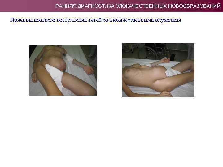 РАННЯЯ ДИАГНОСТИКА ЗЛОКАЧЕСТВЕННЫХ НОВООБРАЗОВАНИЙ Причины позднего поступления детей со злокачественными опухолями 