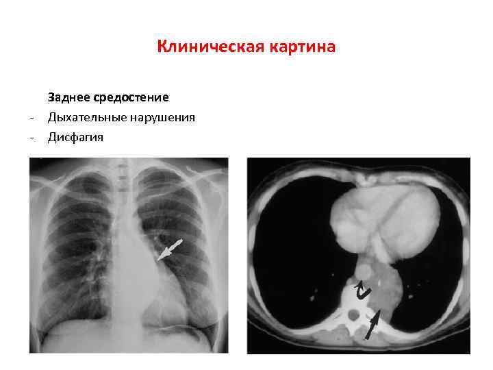 Клиническая картина - Заднее средостение Дыхательные нарушения Дисфагия 