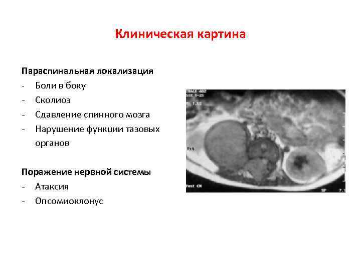 Клиническая картина Параспинальная локализация - Боли в боку - Сколиоз - Сдавление спинного мозга