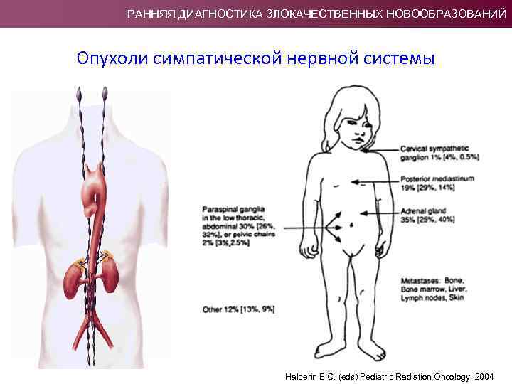 РАННЯЯ ДИАГНОСТИКА ЗЛОКАЧЕСТВЕННЫХ НОВООБРАЗОВАНИЙ Опухоли симпатической нервной системы Halperin E. C. (eds) Pediatric Radiation