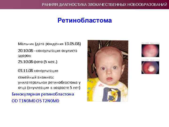 РАННЯЯ ДИАГНОСТИКА ЗЛОКАЧЕСТВЕННЫХ НОВООБРАЗОВАНИЙ Ретинобластома Мальчик (дата рождения 13. 05. 08) 20. 10. 08