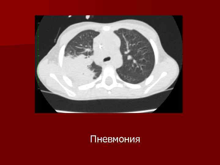 Пневмония 