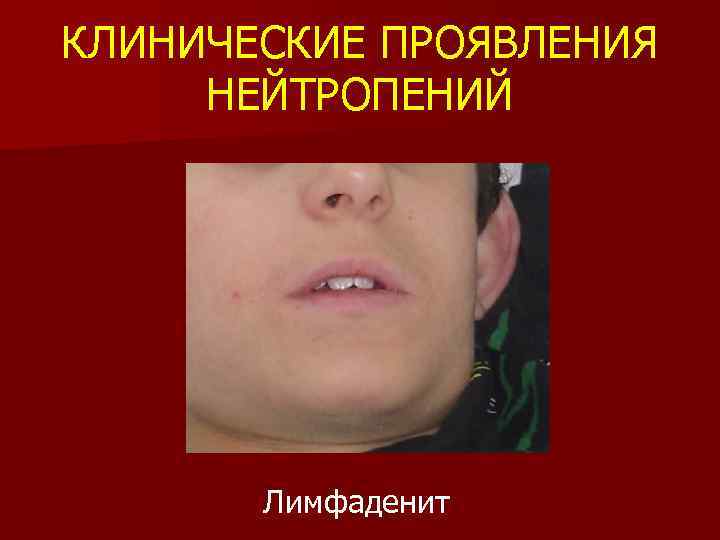 КЛИНИЧЕСКИЕ ПРОЯВЛЕНИЯ НЕЙТРОПЕНИЙ Лимфаденит 