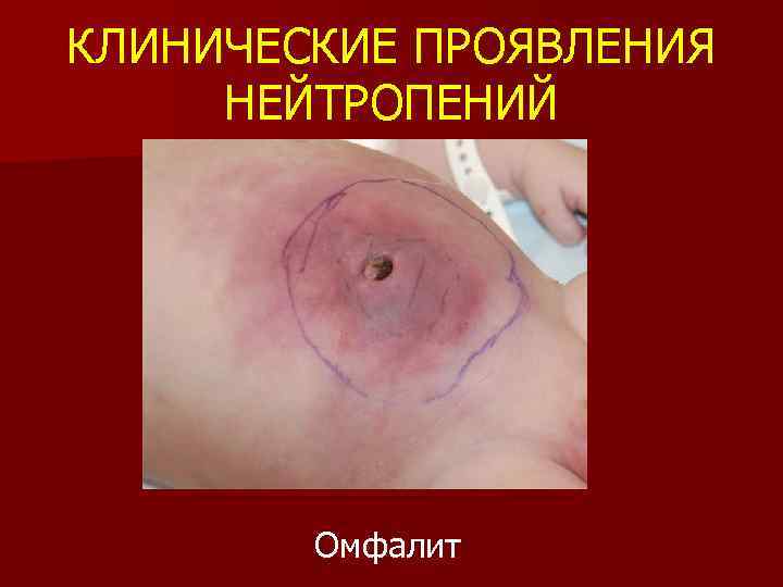КЛИНИЧЕСКИЕ ПРОЯВЛЕНИЯ НЕЙТРОПЕНИЙ Омфалит 