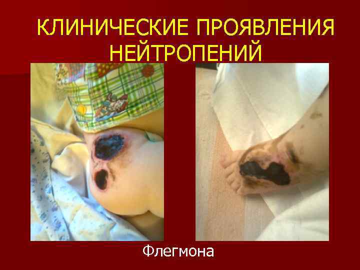 КЛИНИЧЕСКИЕ ПРОЯВЛЕНИЯ НЕЙТРОПЕНИЙ Флегмона 