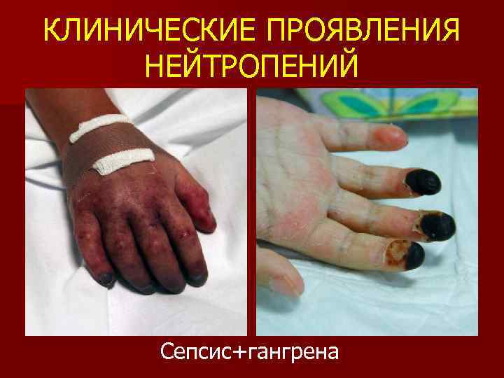 КЛИНИЧЕСКИЕ ПРОЯВЛЕНИЯ НЕЙТРОПЕНИЙ Сепсис+гангрена 