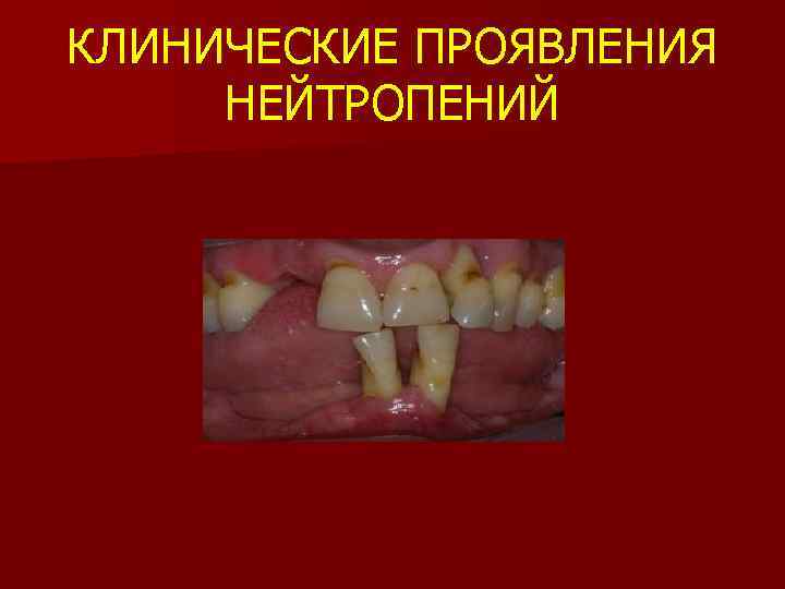 КЛИНИЧЕСКИЕ ПРОЯВЛЕНИЯ НЕЙТРОПЕНИЙ 