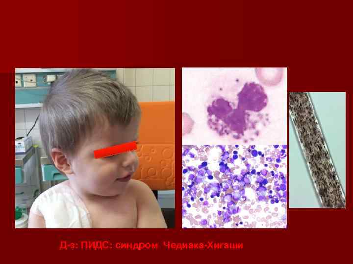 Д-з: ПИДС: синдром Чедиака-Хигаши 