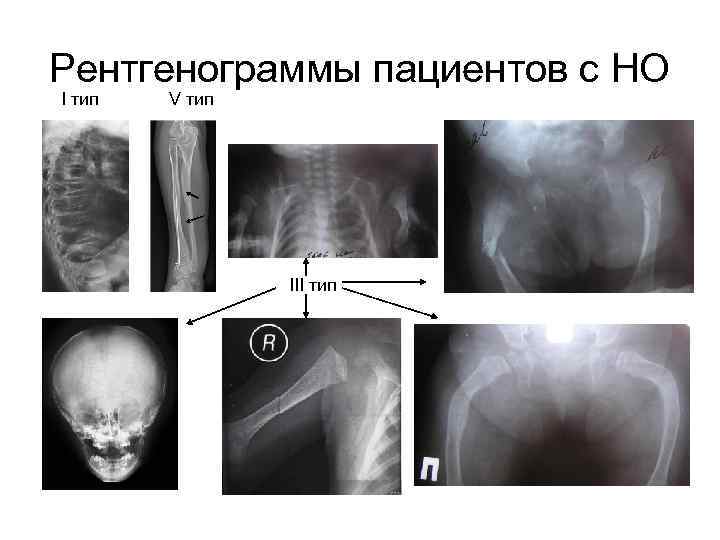 Рентгенограммы пациентов с НО I тип V тип III тип 