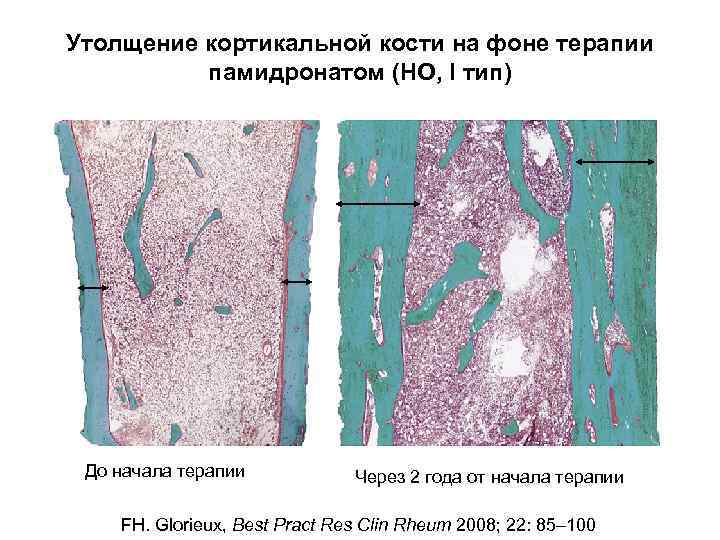 Утолщение кортикальной кости на фоне терапии памидронатом (НО, I тип) До начала терапии Через