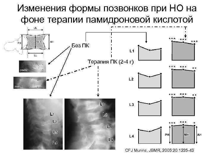 Изменения формы позвонков при НО на фоне терапии памидроновой кислотой Без ПК Терапия ПК