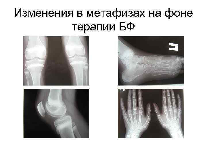 Изменения в метафизах на фоне терапии БФ 