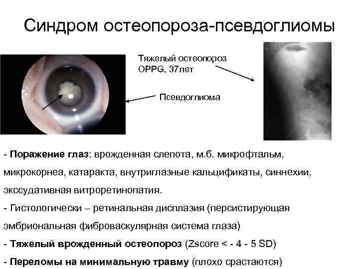Синдром остеопороза-псевдоглиомы Тяжелый остеопороз OPPG, 37 лет Псевдоглиома - Поражение глаз: врожденная слепота, м.