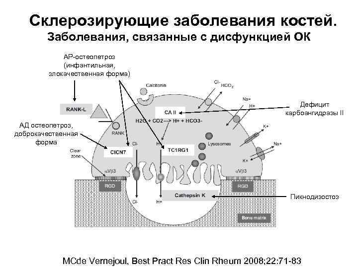 Склерозирующие заболевания костей. Заболевания, связанные с дисфункцией ОК АР-остеопетроз (инфантильная, злокачественная форма) Дефицит карбоангидразы