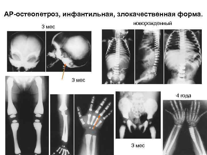 АР-остеопетроз, инфантильная, злокачественная форма. новорожденный 3 мес 4 года 3 мес 
