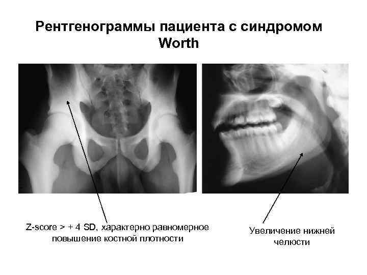 Рентгенограммы пациента с синдромом Worth Z-score > + 4 SD, характерно равномерное повышение костной
