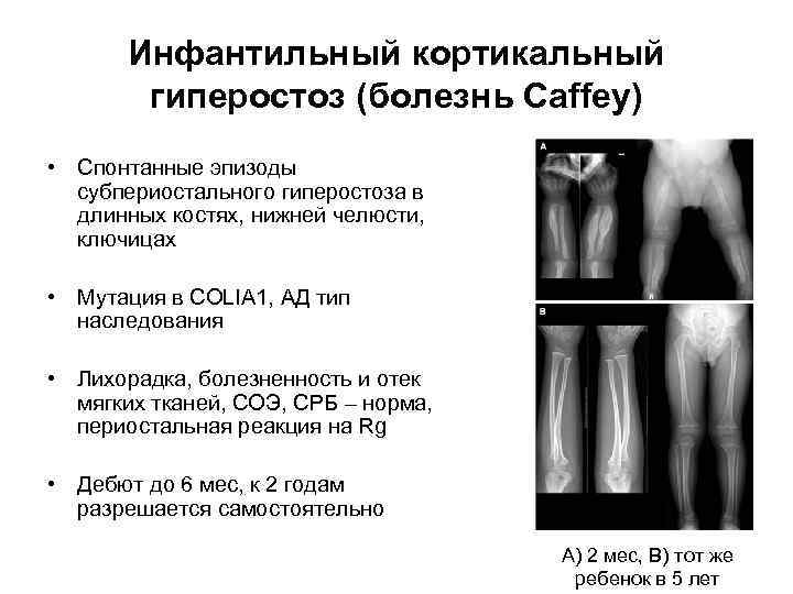 Диффузная кортикальная атрофия