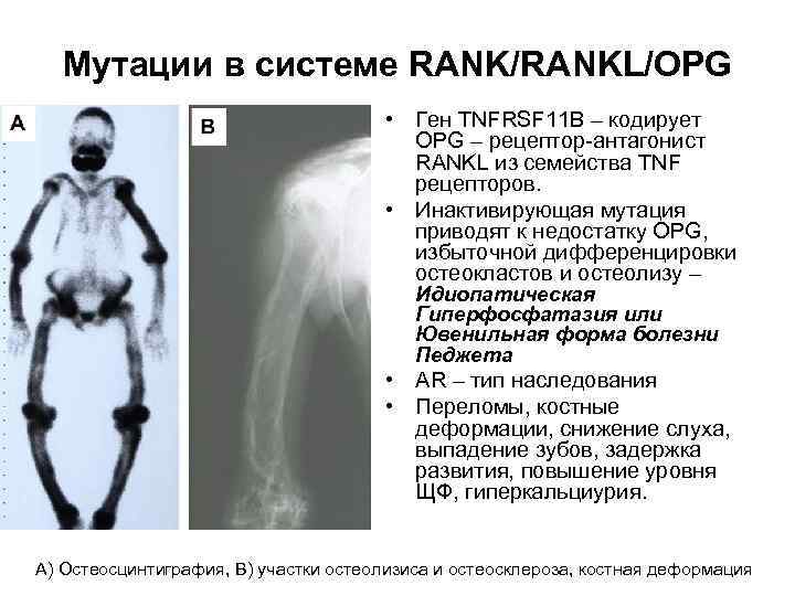 Мутации в системе RANK/RANKL/OPG • Ген TNFRSF 11 B – кодирует OPG – рецептор-антагонист