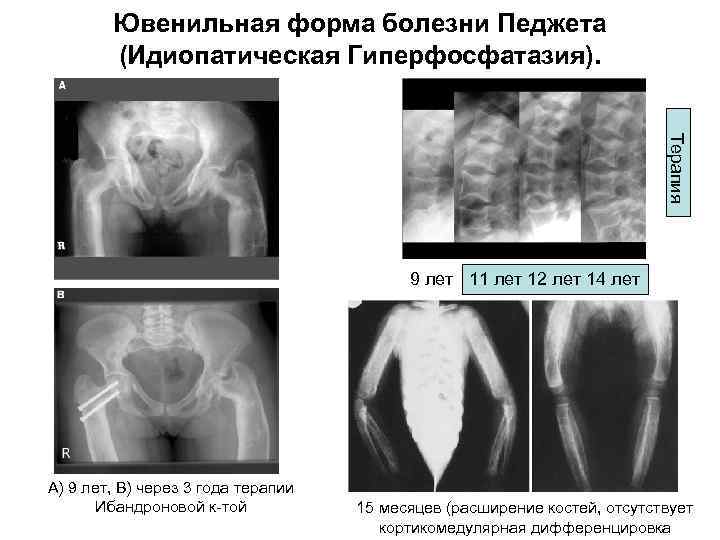 Ювенильная форма болезни Педжета (Идиопатическая Гиперфосфатазия). Терапия 9 лет 11 лет 12 лет 14