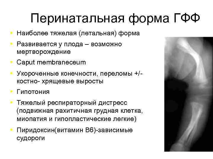 Перинатальная форма ГФФ Наиболее тяжелая (летальная) форма Развивается у плода – возможно мертворождение Caput