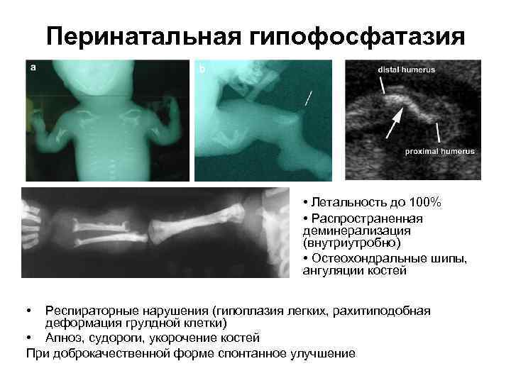 Перинатальная гипофосфатазия • Летальность до 100% • Распространенная деминерализация (внутриутробно) • Остеохондральные шипы, ангуляции