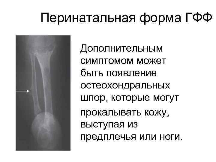 Перинатальная форма ГФФ Дополнительным симптомом может быть появление остеохондральных шпор, которые могут прокалывать кожу,