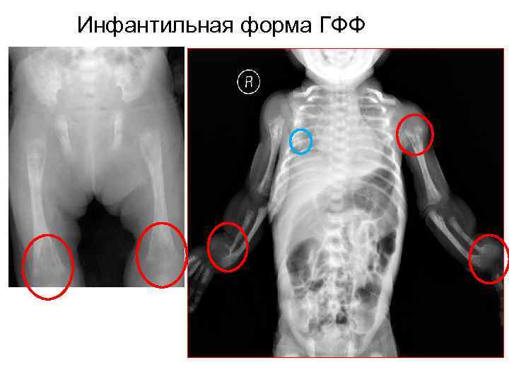 Инфантильная форма ГФФ 