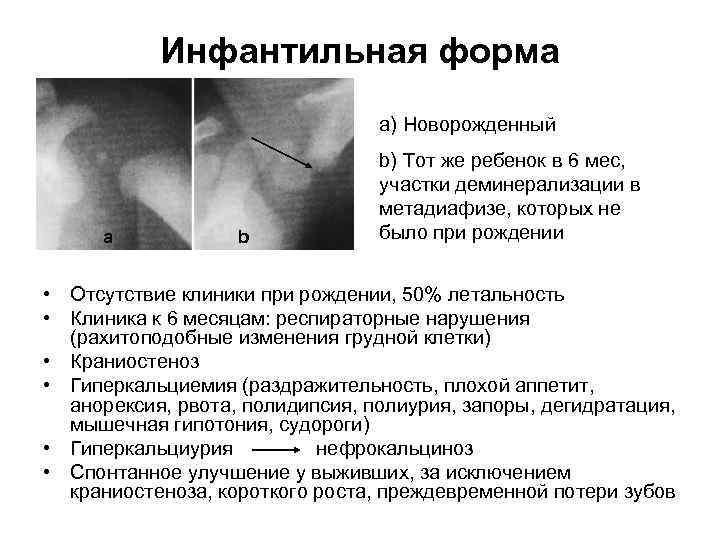 Инфантильная форма a) Новорожденный а b b) Тот же ребенок в 6 мес, участки