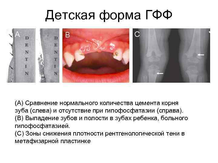 Детская форма ГФФ A B C (А) Cравнение нормального количества цемента корня зуба (слева)