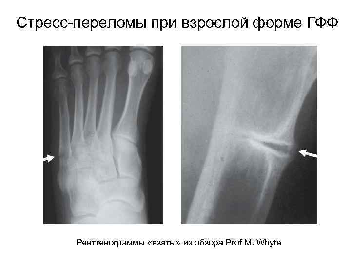 Стресс-переломы при взрослой форме ГФФ Рентгенограммы «взяты» из обзора Prof M. Whyte 