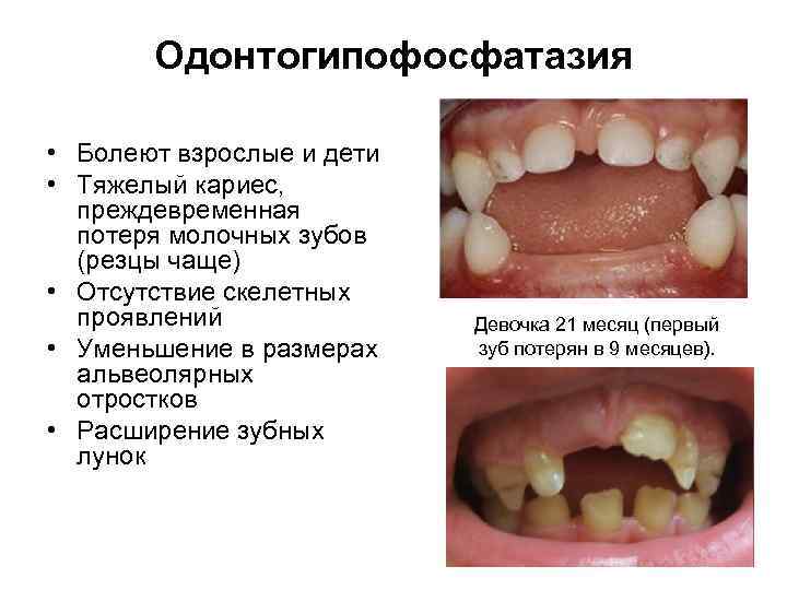 Одонтогипофосфатазия • Болеют взрослые и дети • Тяжелый кариес, преждевременная потеря молочных зубов (резцы