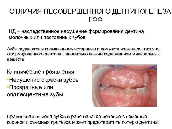 ОТЛИЧИЯ НЕСОВЕРШЕННОГО ДЕНТИНОГЕНЕЗА ГФФ НД – наследственное нарушение формирования дентина молочных или постоянных зубов