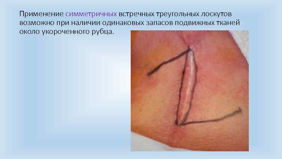 Применение симметричных встречных треугольных лоскутов возможно при наличии одинаковых запасов подвижных тканей около укороченного