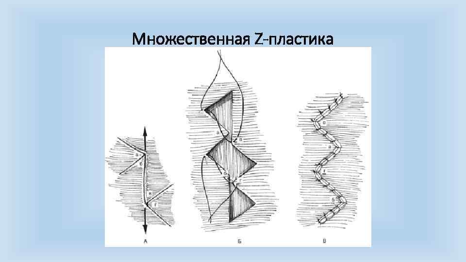 Френулопластика по Лимбергу (Z-образная)