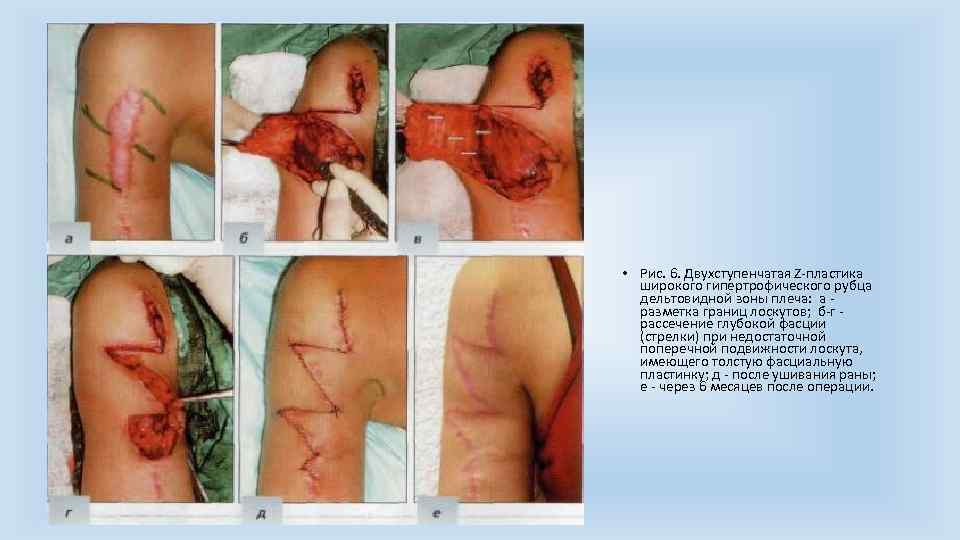  • Рис. 6. Двухступенчатая Z пластика широкого гипертрофического рубца дельтовидной зоны плеча: а