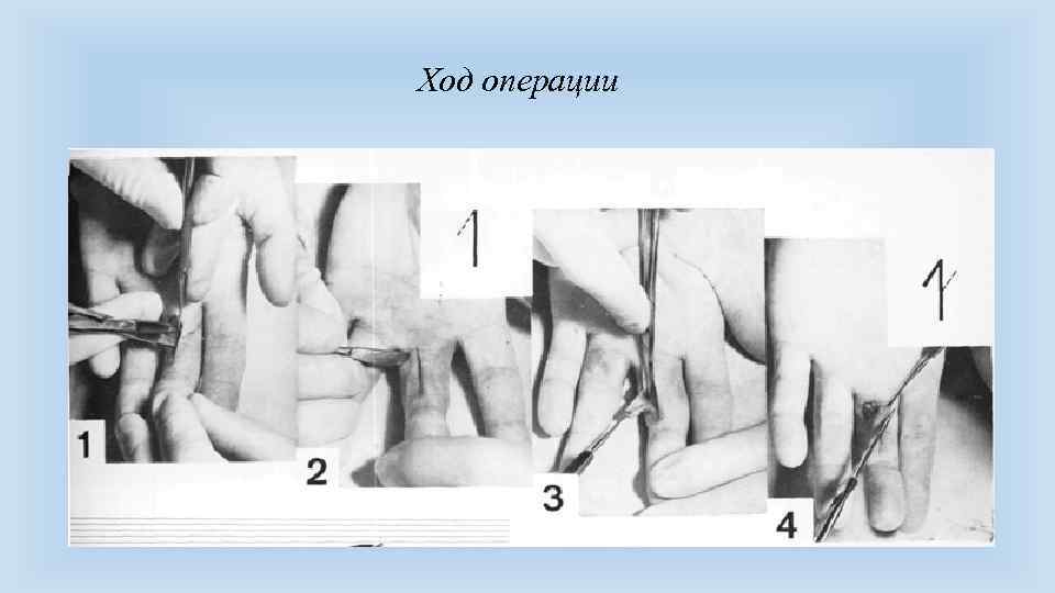 Ход операции 