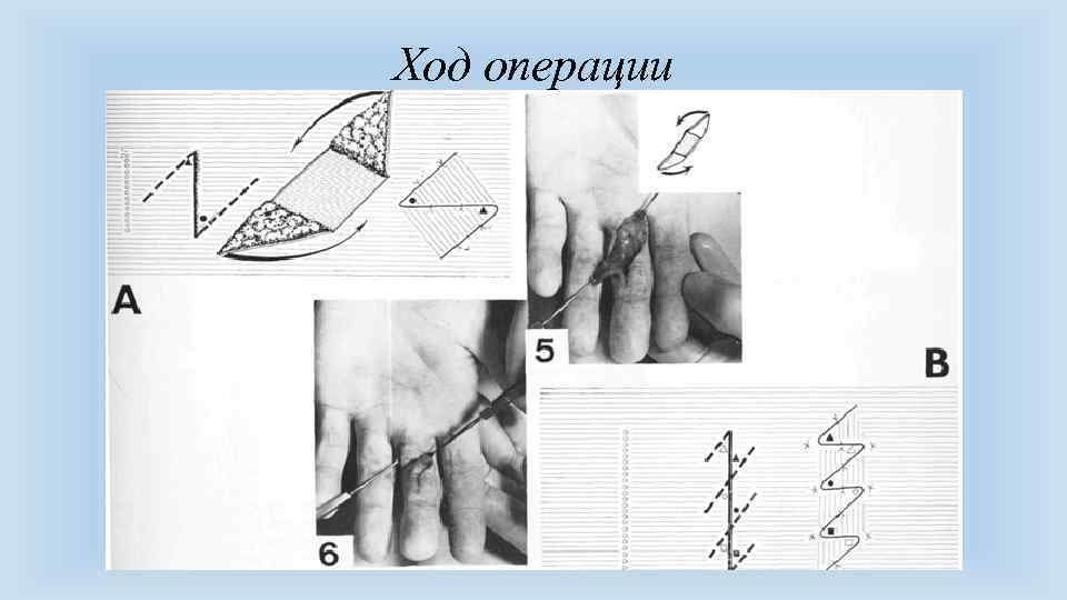 Ход операции 