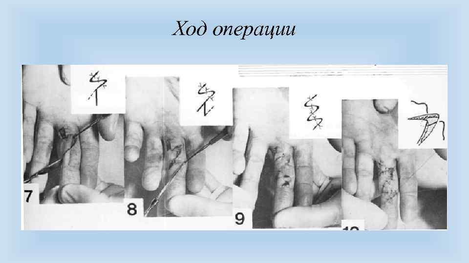 Ход операции 