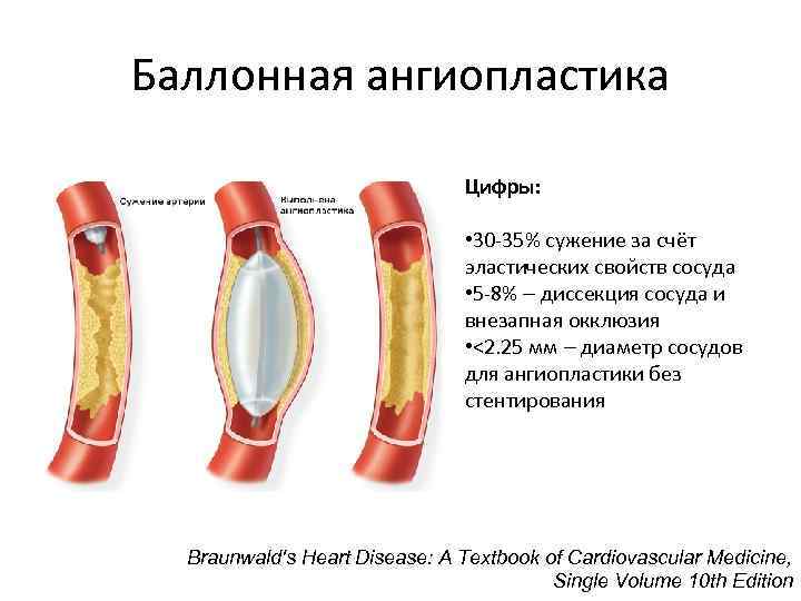 Ангиопластика. Баллонная ангиопластика и стентирование артерий сердца. Баллон для стентирования. Ангиопластика коронарных артерий без стентирования. Диссекция коронарной артерии.