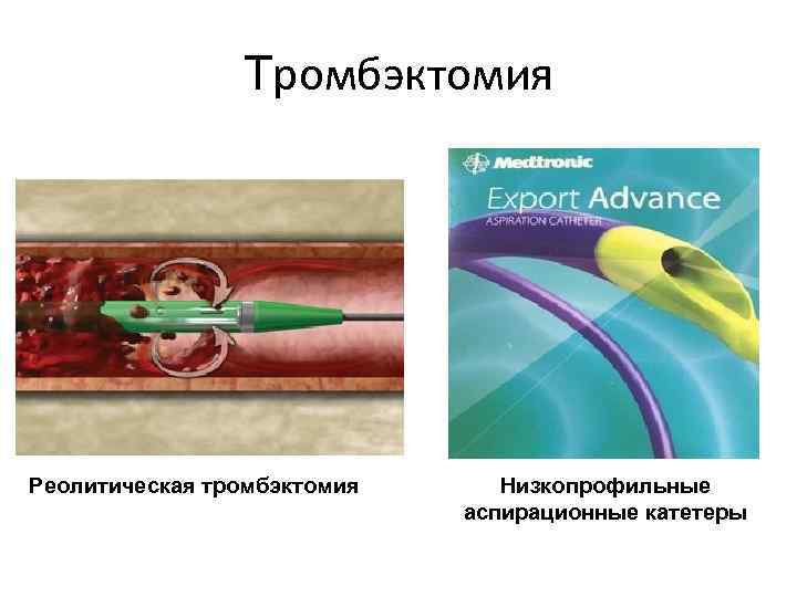Тромбэктомия Реолитическая тромбэктомия Низкопрофильные аспирационные катетеры 