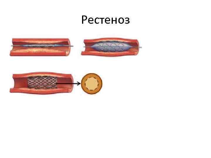 Рестеноз 