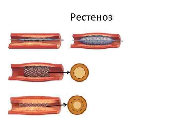 Рестеноз 