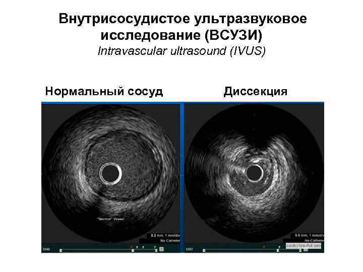 Внутрисосудистое ультразвуковое исследование (ВСУЗИ) Intravascular ultrasound (IVUS) Нормальный сосуд Диссекция 