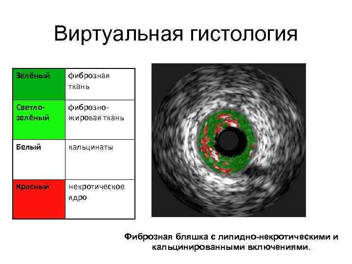 Виртуальная гистология Зелёный фиброзная ткань Светлозелёный фиброзножировая ткань Белый кальцинаты Красный некротическое ядро Фиброзная