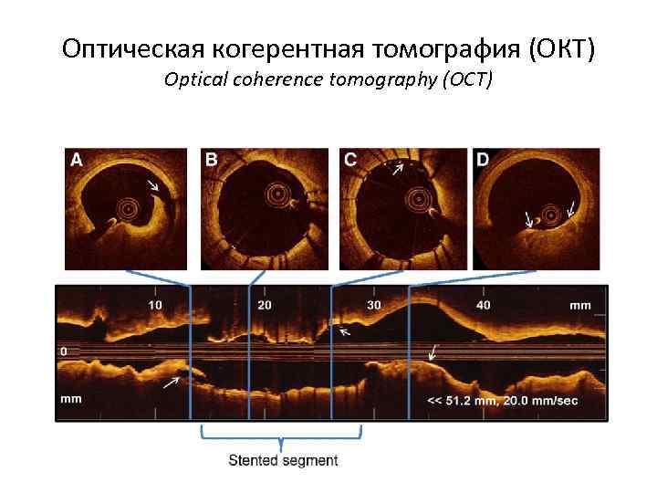 Оптическая когерентная томография (ОКТ) Optical coherence tomography (OCT) 