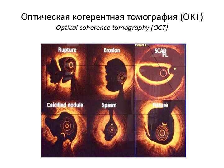 Оптическая когерентная томография (ОКТ) Optical coherence tomography (OCT) 